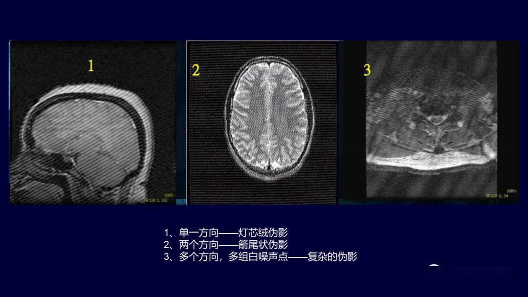 mri常见伪影的原因,表现及其对策