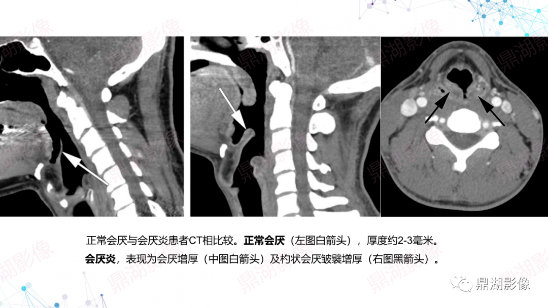 会厌炎影像表现