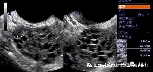 什么叫做多囊卵泡 7cbaf90aa4094d15852bb928f97917cd.png