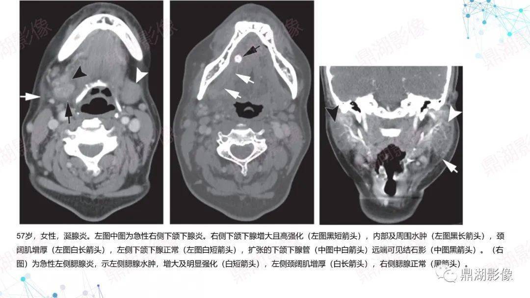 涎腺炎