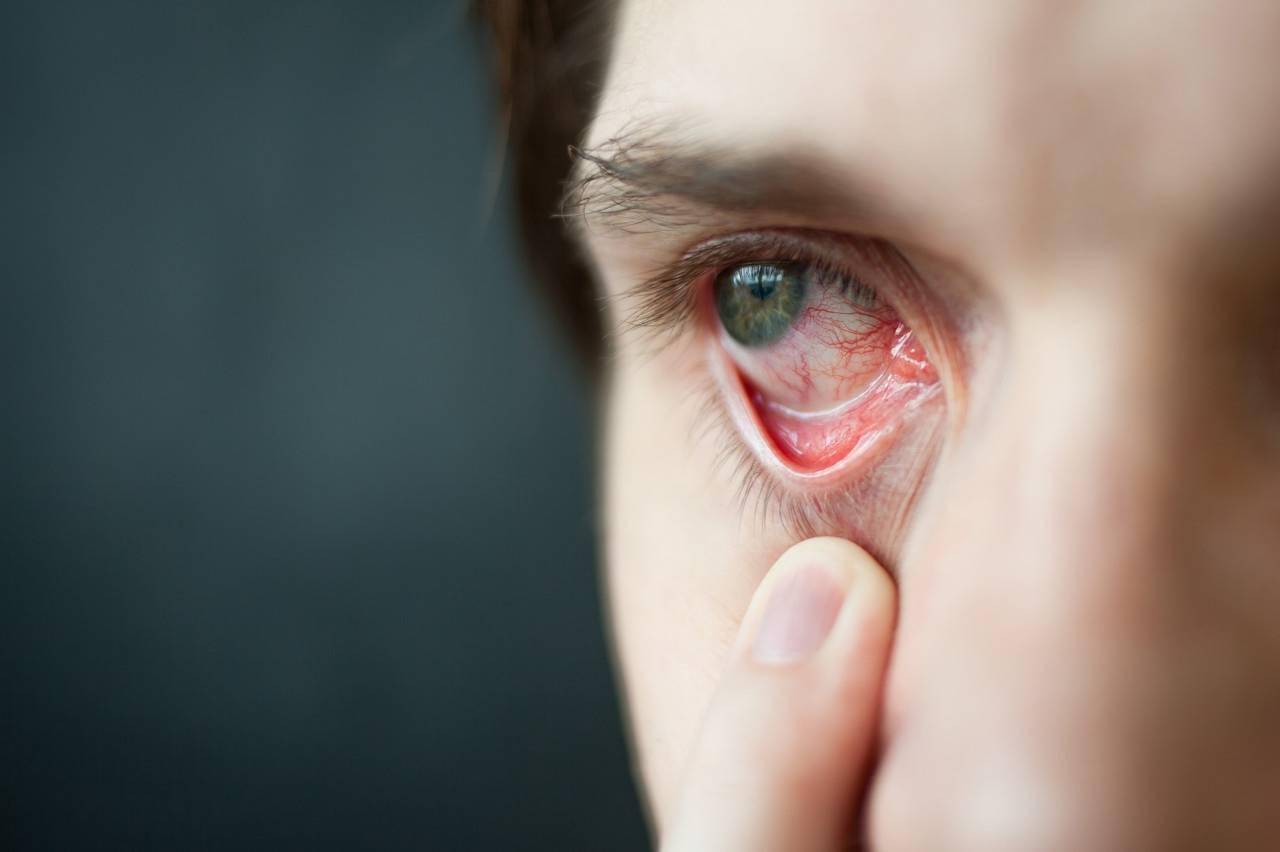 眼睛肿是什么原因（眼睛肿怎么快速消肿） | 说明书网