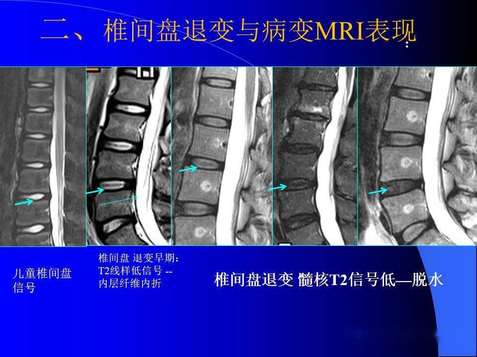 椎间盘发育,退变与病变mri表现