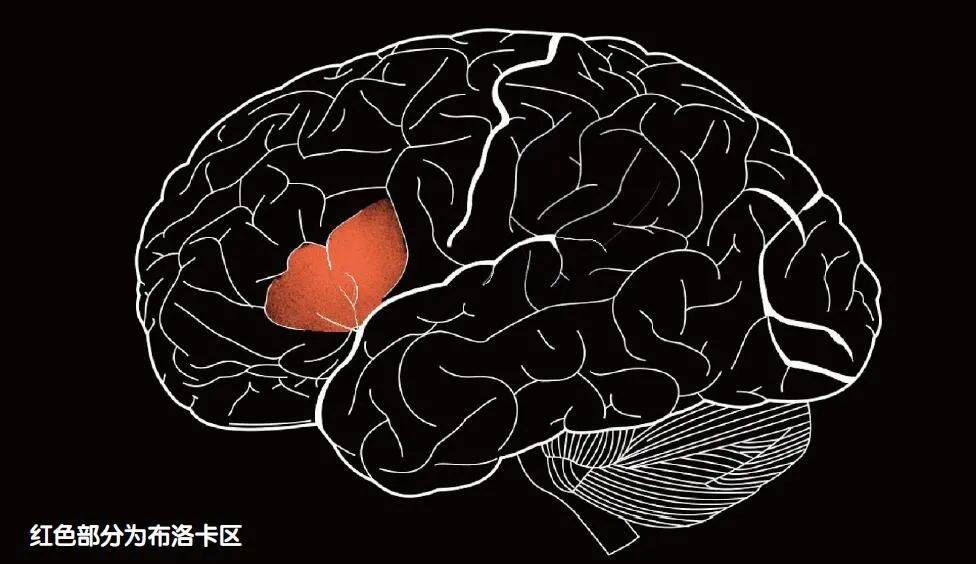 神经科学家对布洛卡区的认识正是来自tan先生的案例,如今他的案例被