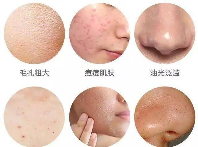 玉容芳菲柳佳明:亚洲人问题性肌肤如何修护?_皮肤