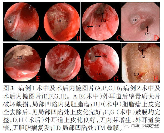 内镜下shin Ⅲ期外耳道胆脂瘤手术治疗初探