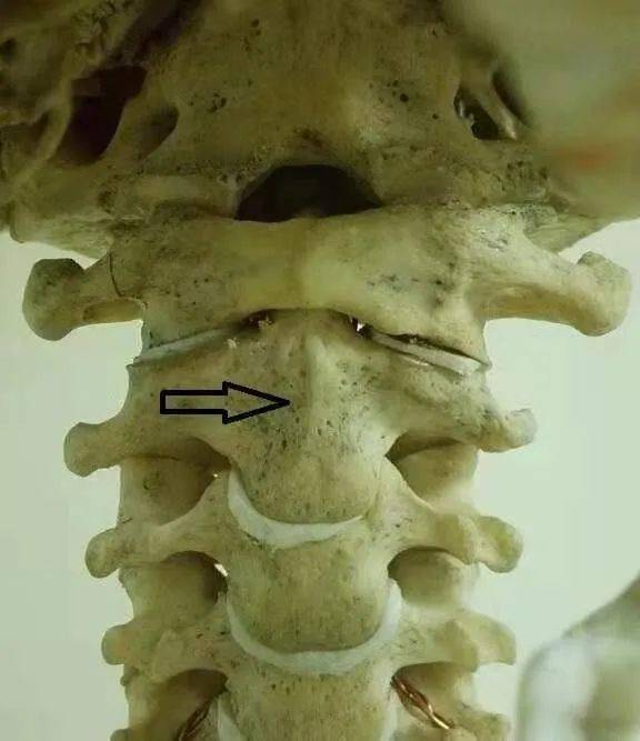 主任易善钧立即嘱咐患者卧床休息,枢椎齿状突骨折(Ⅱ型)并寰枢关节半