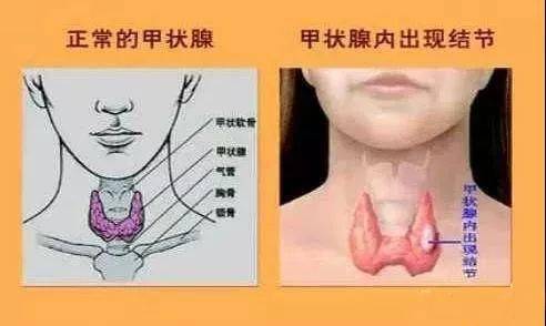 甲状腺结节为什么不要盲目手术