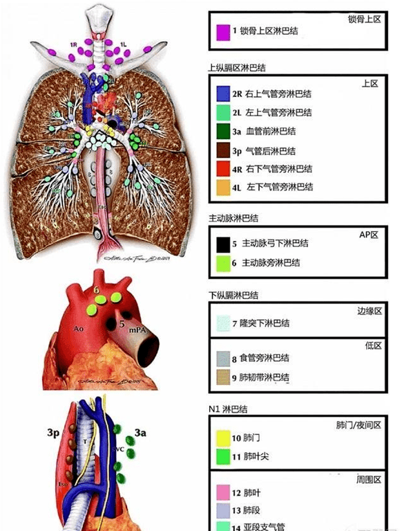 摸象之一目了然的纵隔淋巴结分区