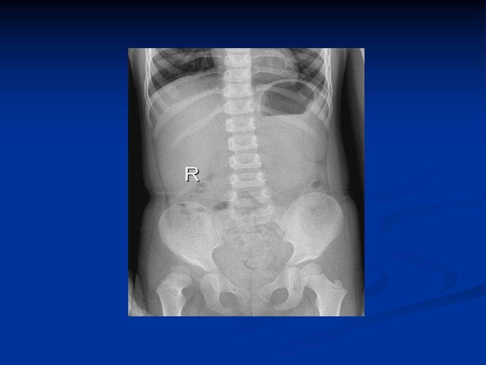 1,x线卧位腹部平片:充气扩大的小肠呈连贯的透亮影,横贯腹腔之大部