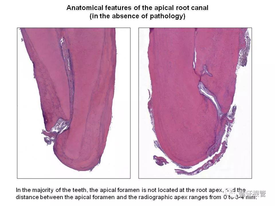 的切片,这种单根管,根尖孔正好位于牙根尖端,且无任何根尖分歧的结构