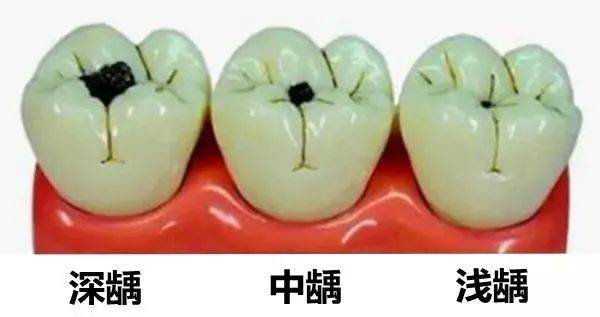 要是比较轻度的龋齿,比如说牙齿上有一些"黑线",没有出现黑洞洞的话