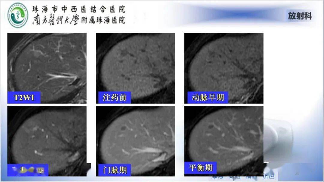 肝脏影像分段及肝硬化结节mri诊断