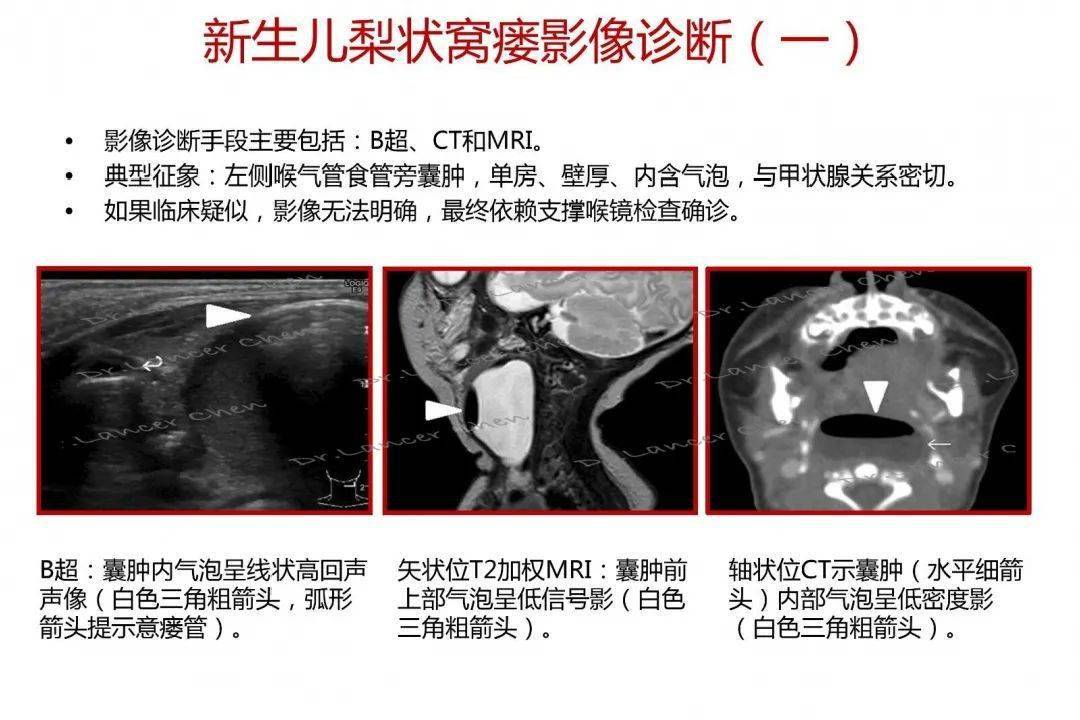 【卫生社团】"性"相近,"表"相远:新生儿梨状窝瘘,不一