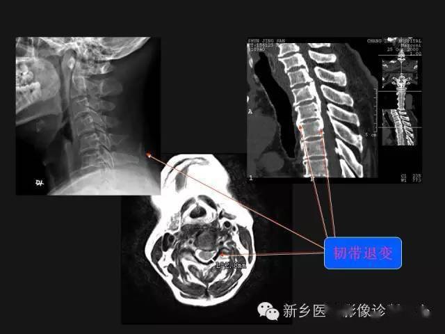 颈椎病的影像诊断,看完深刻理解!