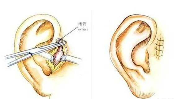 诊治参考耳后瘘管的诊断与治疗
