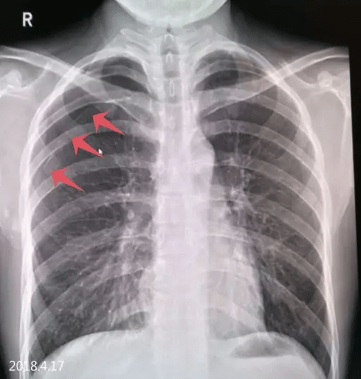 肺见大片状无肺纹理通过透亮区,肺组织被压缩约?%,肺组织压缩呈?