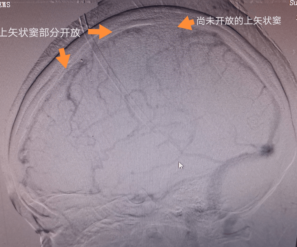 技术前沿 23岁逄女士突发脑梗死,静脉窦内接触溶栓术成功挽救患者