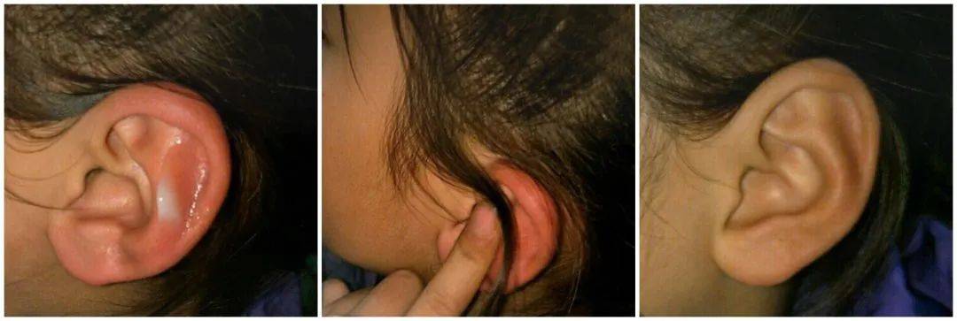 小朋友的耳朵也很容易被冻伤  出门前可以抹上预防冻疮 已经有冻疮的