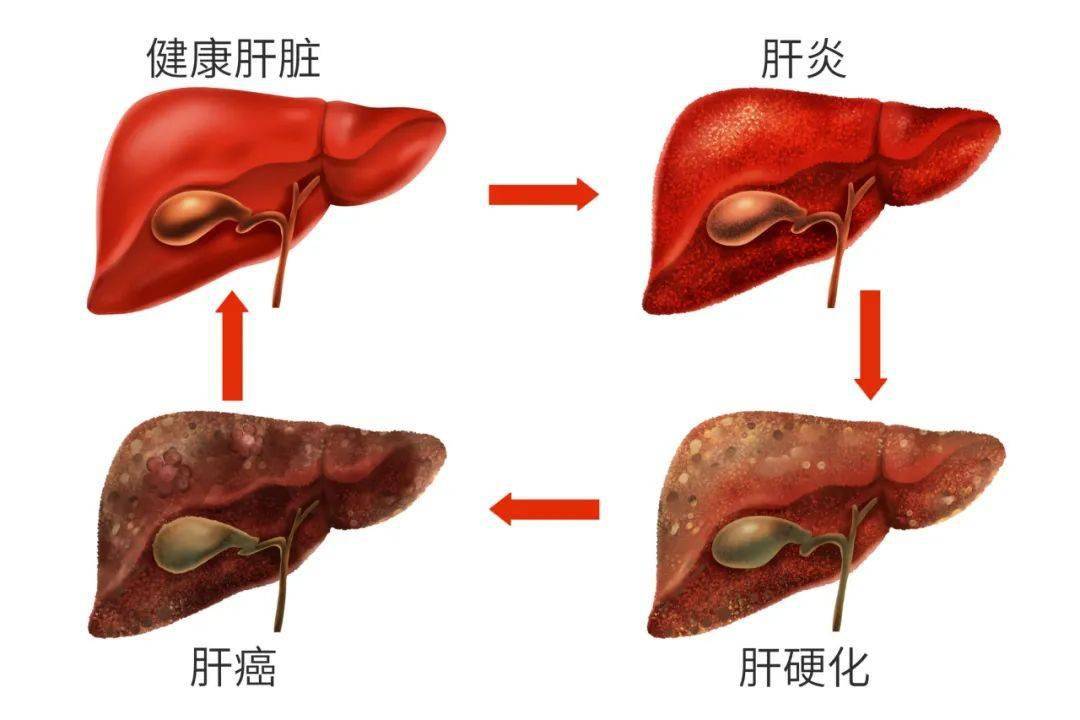 关爱健康 | 经常在外面吃饭,可能会染上肝炎吗?