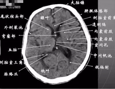 简明又详细的头部ct读片详解,收藏_脑室