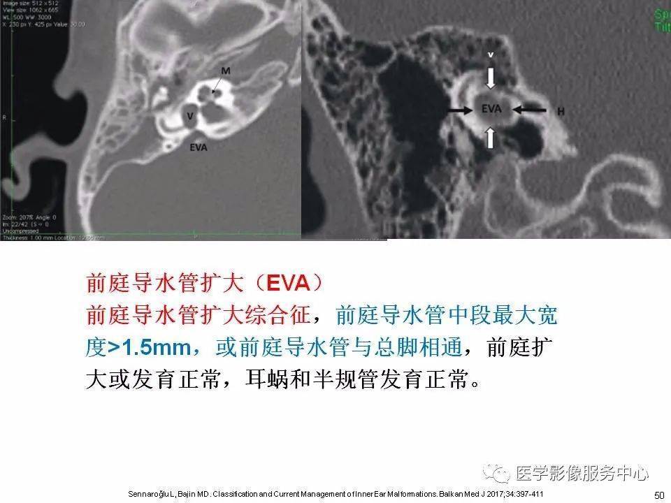 内耳正常解剖及畸形分类