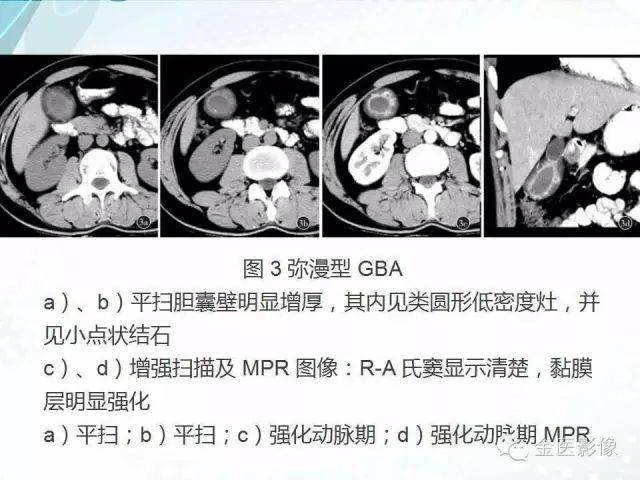 胆囊腺肌症影像表现及鉴别