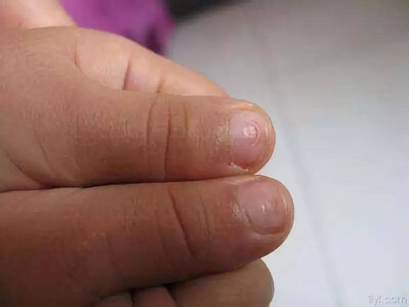 宝宝指甲有这6种表现的,家长一定要警惕!