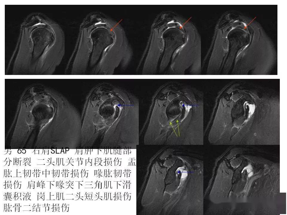 肩关节韧带及损伤的mr表现