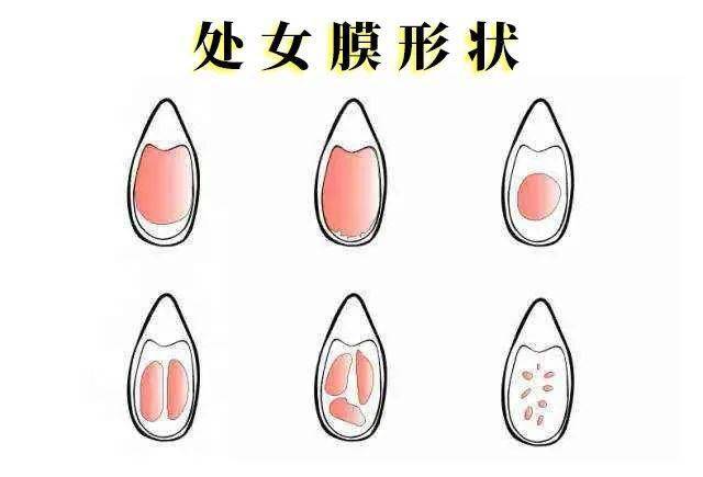 而且 处女膜本身就存在很多的洞(不然姨妈怎么出来),所以,不要再去