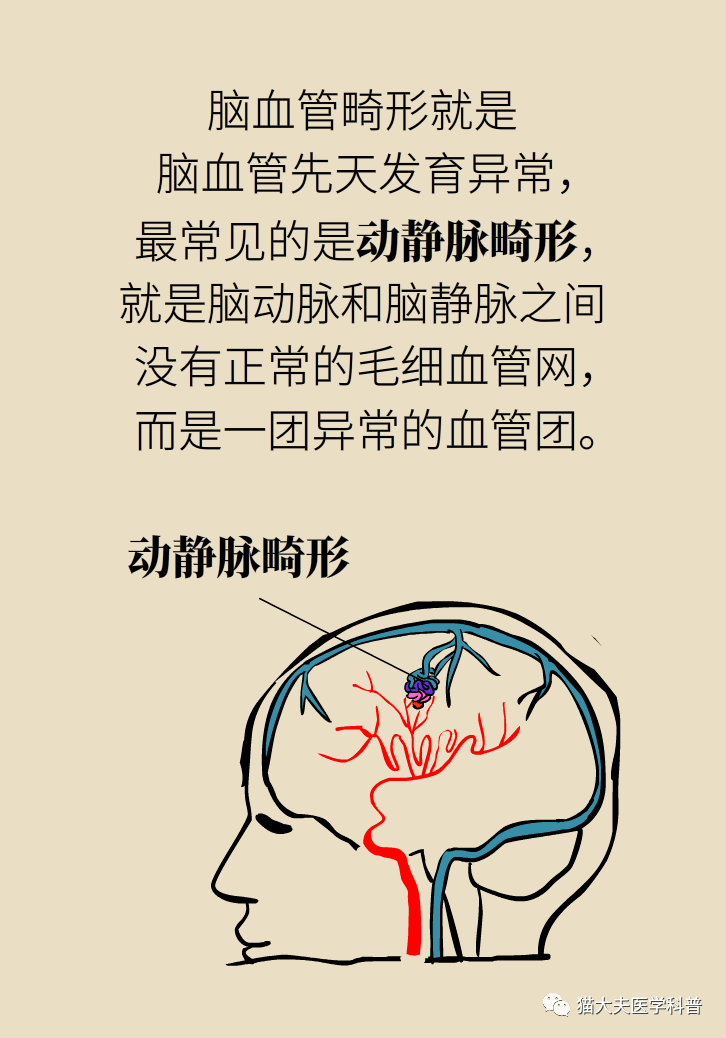 脑血管畸形是什么鬼是天生的吗