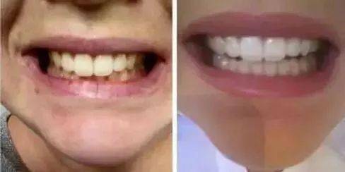 变态发明!360度溶解陈年牙垢,比洗牙还干净9527倍!打