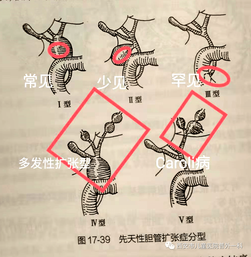 胆管扩张症手术疤痕从8-15cm变成3cm,普外一科是怎么做的?