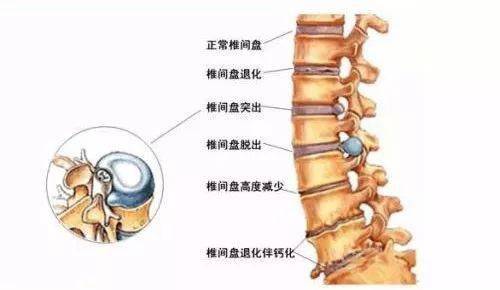 为什么越来越多年轻人也有腰椎间盘突出