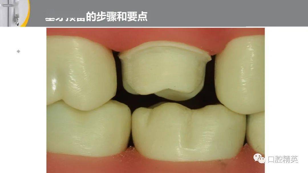 全冠的牙体预备前后牙