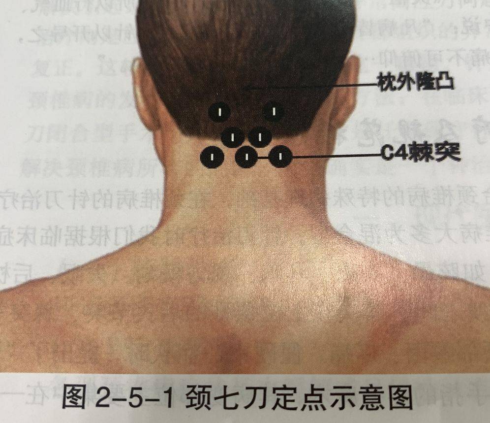 松解方法: ①头后大直肌与头上斜肌止点 (压痛点1,2)刀口线与颈椎