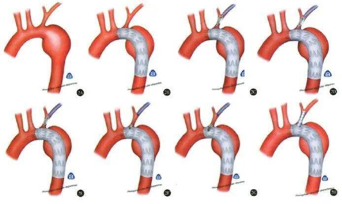 如何提高ankura 胸主动脉支架穿刺针原位开窗成功率(一)_手机搜狐网
