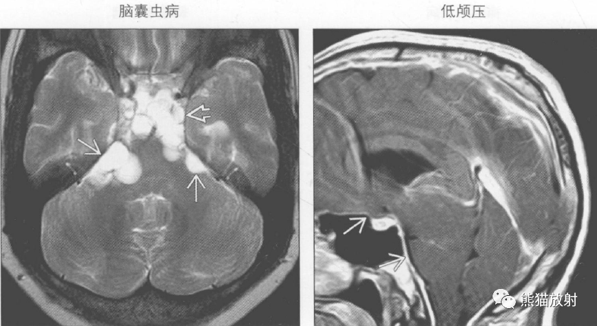 鉴别诊断丨桥前池肿块