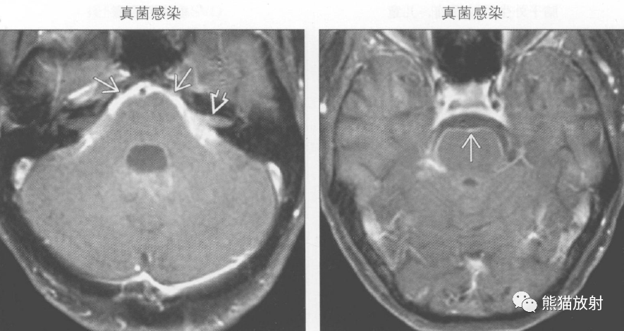 鉴别诊断丨桥前池肿块