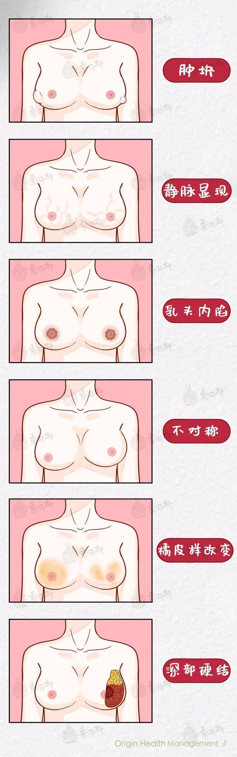 女性乳腺癌发病数首超肺癌:别生气了,真的要命