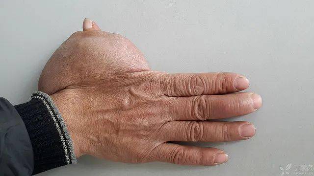 简要病史:中指远节指间关节外伤 2 小时.既往拇指肿物 4  余年.