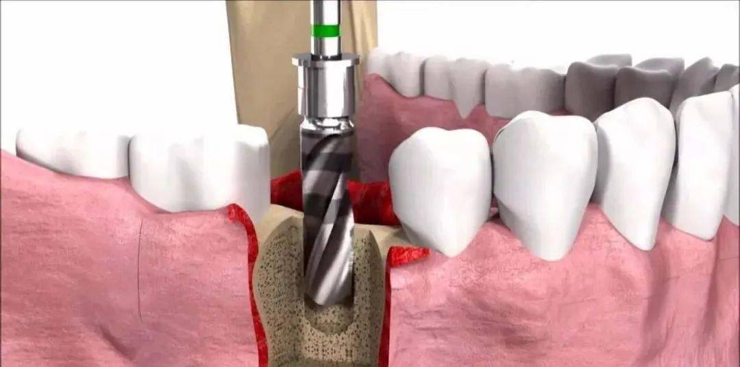 数字化技术运用使种植牙过程更加微创,不仅能全方位查看到牙齿及牙槽