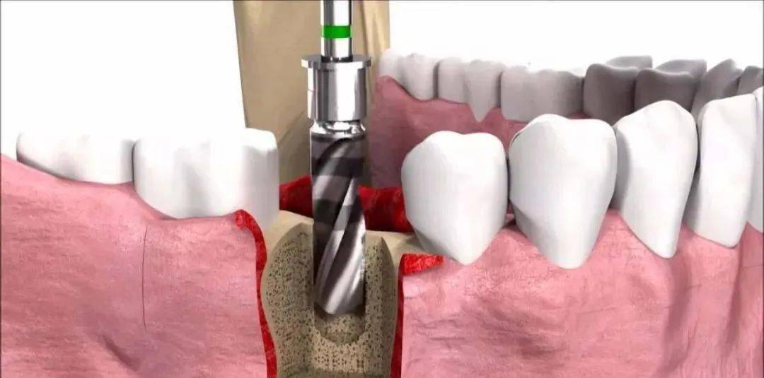 种植牙和拔牙对比解读!