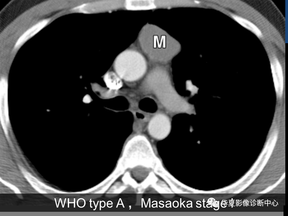 胸腺瘤影像诊断及分期