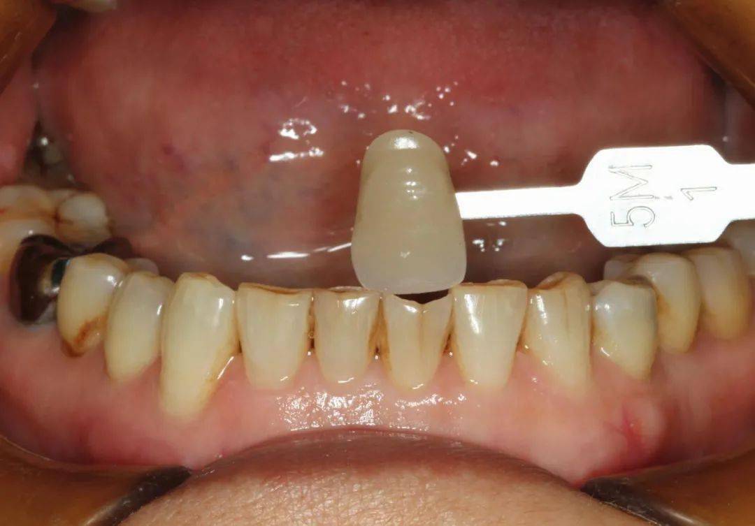 牙体预备:仅进行了边缘的调磨,形成清晰边缘线.