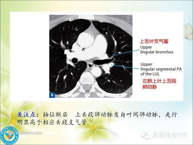 推荐丨肺动脉和肺静脉影像断层解剖