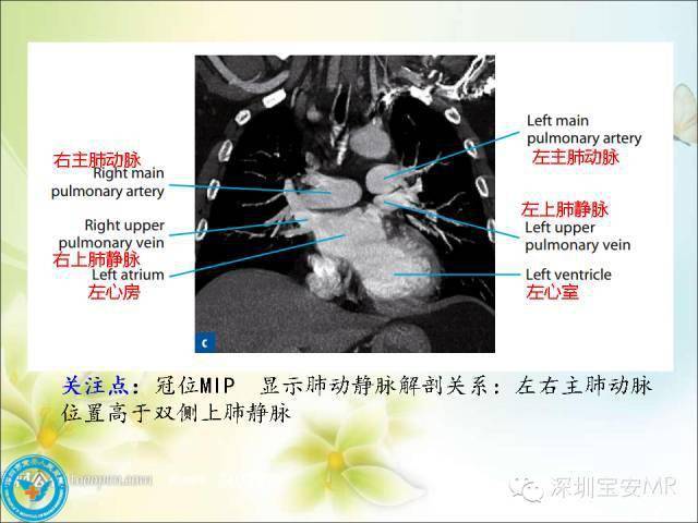 推荐丨肺动脉和肺静脉影像断层解剖