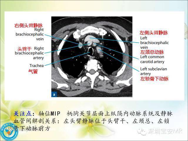 推荐丨肺动脉和肺静脉影像断层解剖