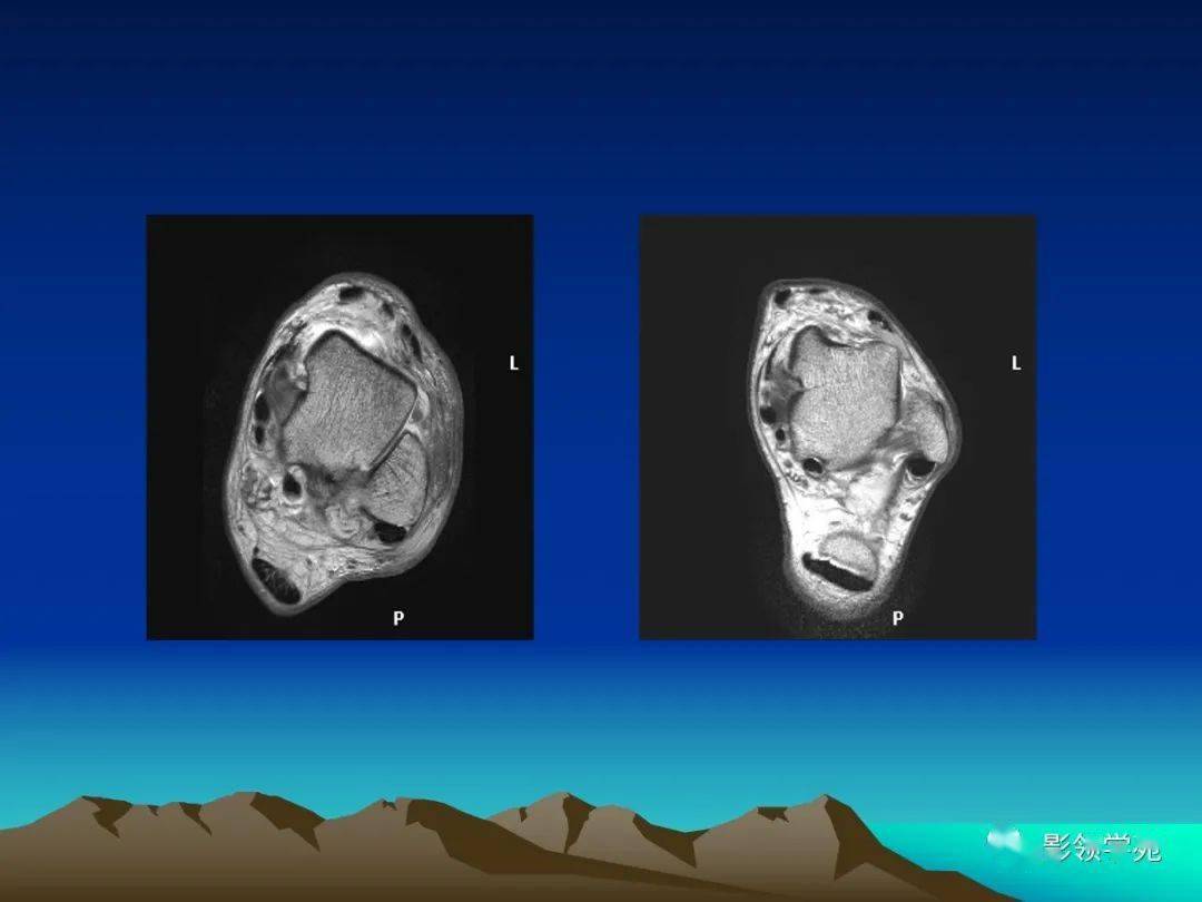 踝关节外侧韧带急性损伤的mri表现