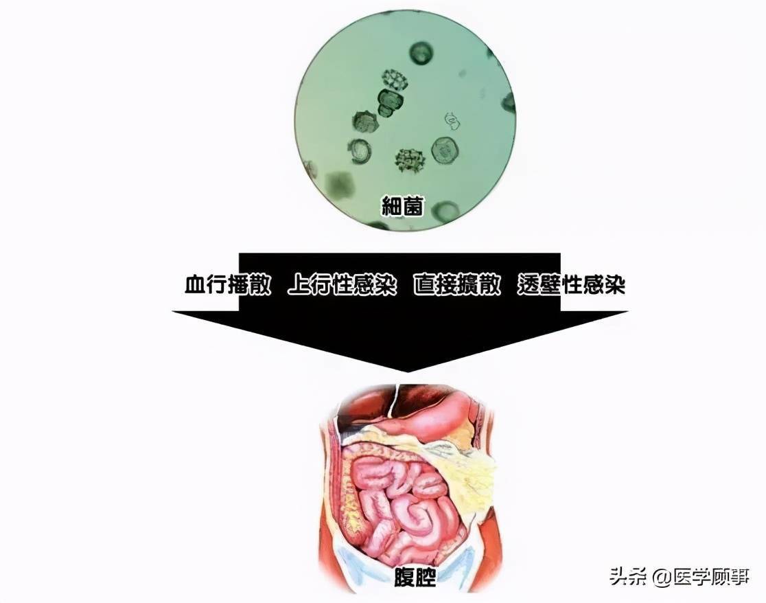 急性弥漫性腹膜炎