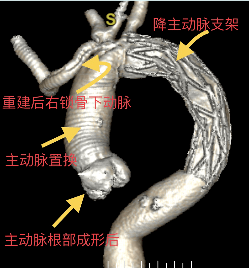 【重医三院·医疗动态】我院成功完成一例a型主动脉夹层合并主动脉弓